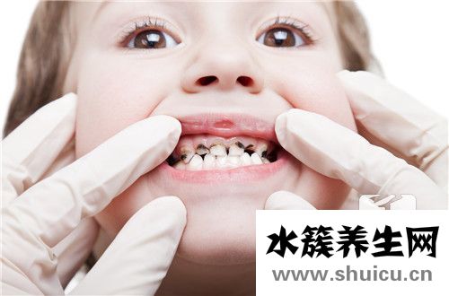 蛀牙是怎么形成的