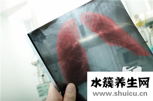 肺大泡是什么病