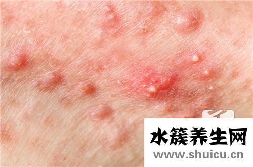 閉口和粉刺的區別