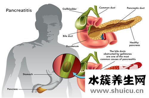 膽囊壁膽固醇結(jié)晶