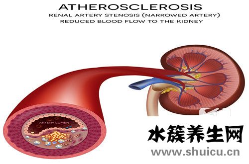 主動(dòng)脈鈣化