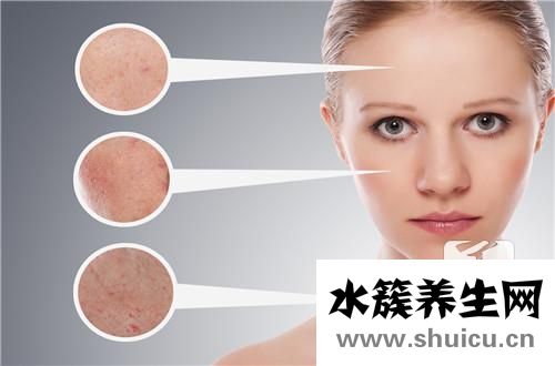 結(jié)節(jié)囊腫型痤瘡