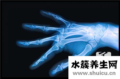 骨折后怎樣恢復得快