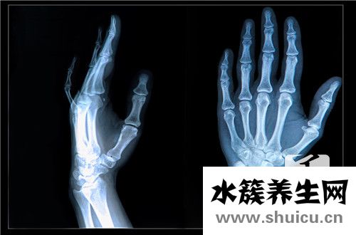 橈骨遠(yuǎn)端骨折