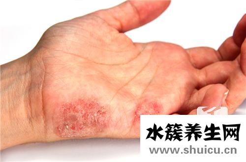 汗皰疹用什么藥膏