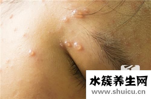 水痘是怎么引起的