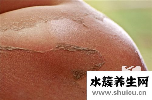 被太陽曬傷了怎么辦