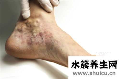 靜脈曲張硬化劑