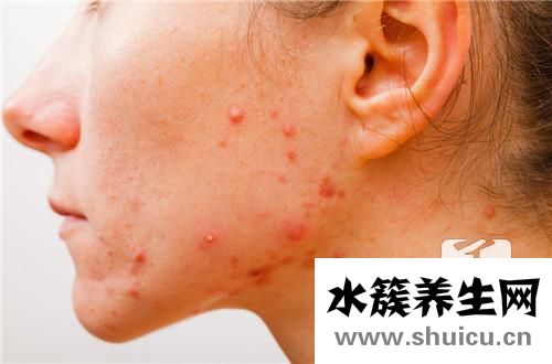 青春痘多久才會好