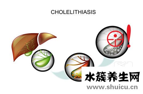 膽囊炎患者吃什么好