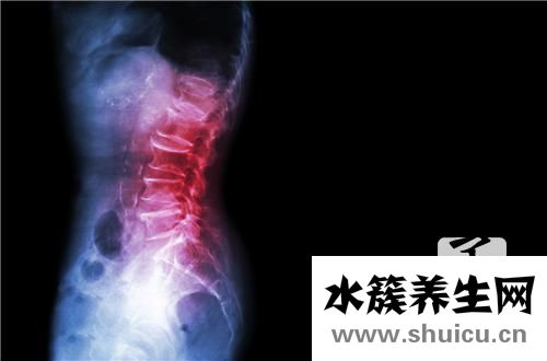 強直性脊柱炎如何確診