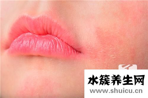 激素性皮炎癥狀