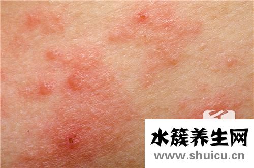 發(fā)燒后出疹子