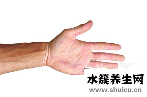 什么是紅斑狼瘡