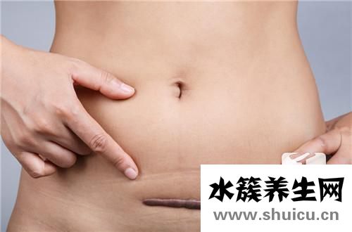剖腹產(chǎn)疤