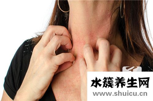 脂溢性皮炎能治好嗎