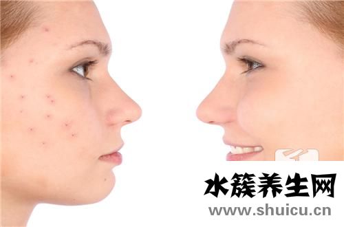 臉上有痘痘怎么辦
