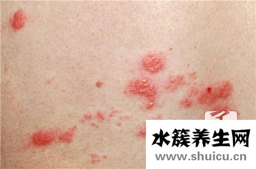 帶狀皰疹后遺神經(jīng)痛治療