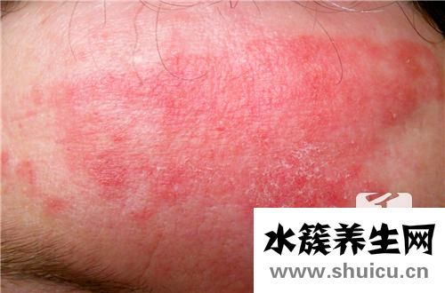 蕁麻疹嚴(yán)重嗎