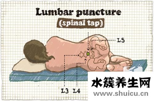 多發性末梢神經炎