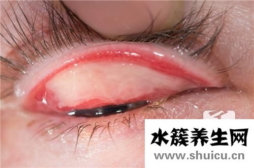 眼結石怎么治療