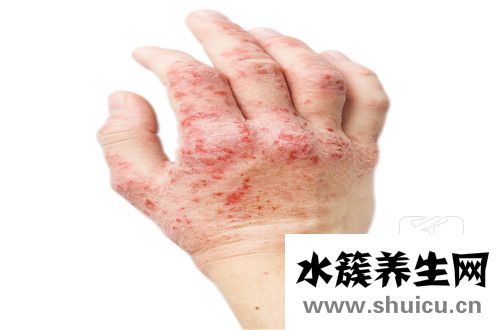 艾滋病皮疹圖片