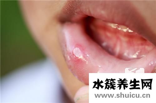 口舌生瘡
