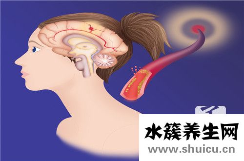 腦血栓病人吃什么好