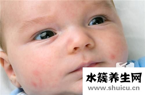 新生兒濕疹