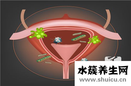 男性膀胱鏡檢查