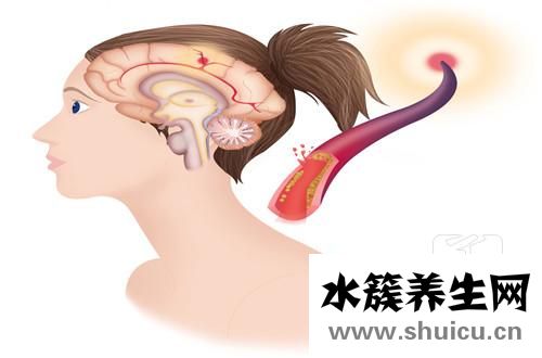 腦白質缺血性改變