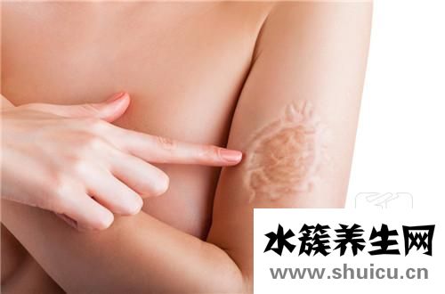 有誰疤痕疙瘩被治好了