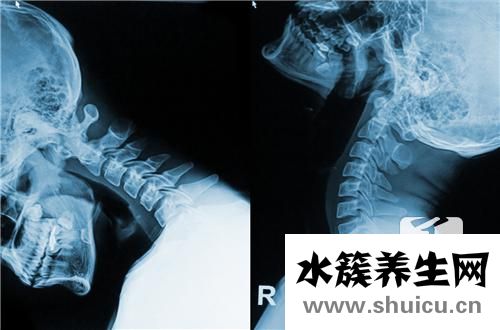 椎動脈供血不足