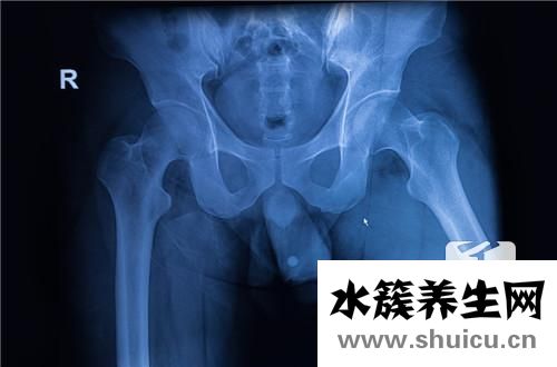 致密性骶髂關節炎