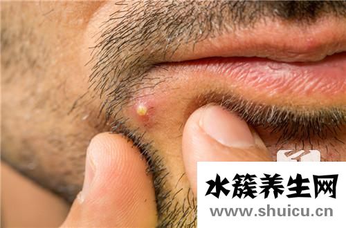 帶狀皰疹后續治療