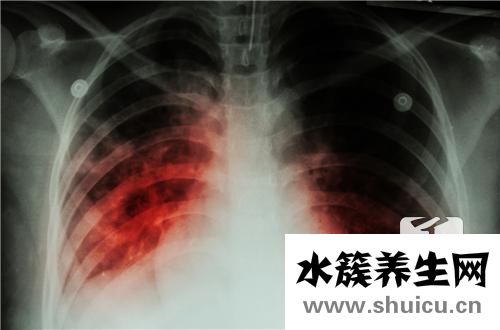 肺結核病人能活多久