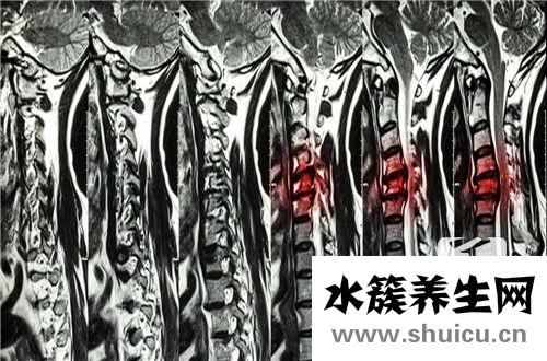 頸椎鈣化是什么意思