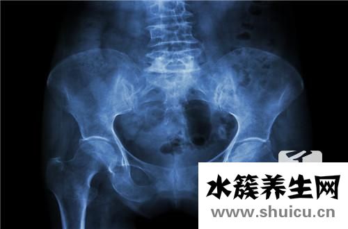 雙側(cè)骶髂關(guān)節(jié)炎