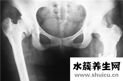 雙側(cè)骶髂關(guān)節(jié)炎