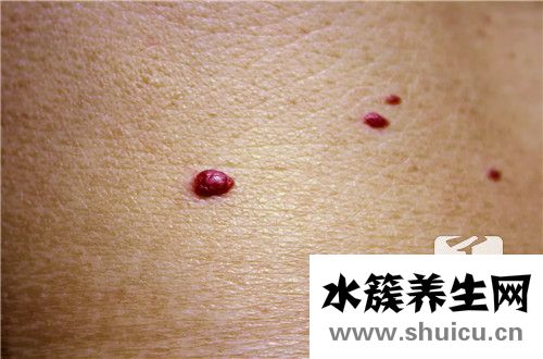 血管瘤是什么引起