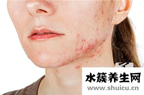 長水痘可以洗澡嗎