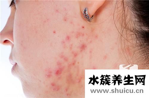 長水痘可以洗澡嗎