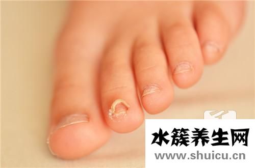 醋精可以治灰指甲嗎