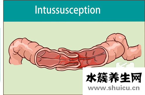 腸結(jié)核好發(fā)部位