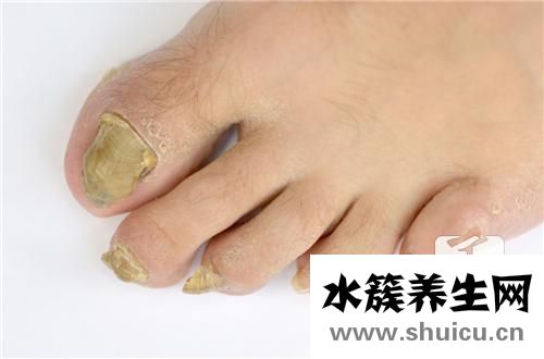 腳趾甲發(fā)黑同