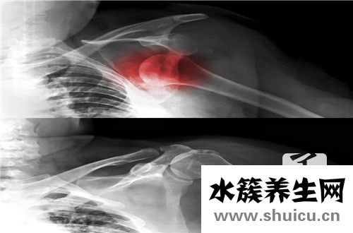 髂骨致密性骨炎