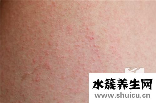 急性蕁麻疹多久能好