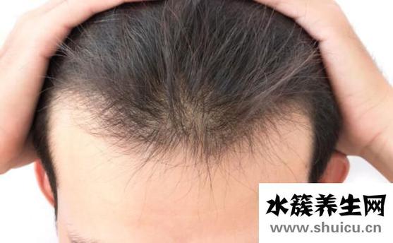 頭發(fā)禿頂怎么治療