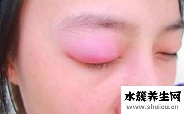 上眼皮腫是什么原因