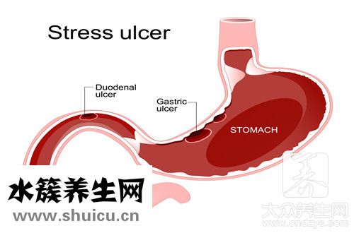 十二指腸間質瘤